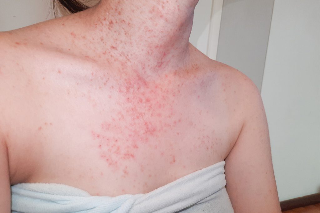 Malassezia Folliculitis