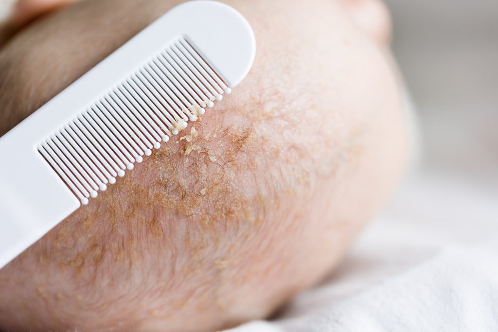 Cradle Cap Flakes On A White Comb Removed From Baby's Head