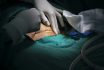 Surgeon Or Doctor And Assistants Hands Wearing Surgical Sterile Gloves Doing Surgical Procedure Or Operation With Skin Incision Under High Key Light Tone Of Surgical Lamp