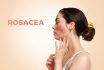 Portrait Of A Young Beautiful Caucasian Woman With Reddened And Inflamed Blood Vessels On Her Cheeks.beige Background.side View.the Inscription Rosacea.the Concept Of Rosacea, Couperose And Healthcare