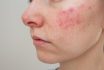 Woman Suffering From The Skin Chronic Disease Rosacea On Her Face In The Acute Stage.