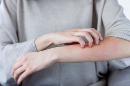 A viszkető bőr is lehet rossz jel / Kép forrása: monstArrr / Getty Images