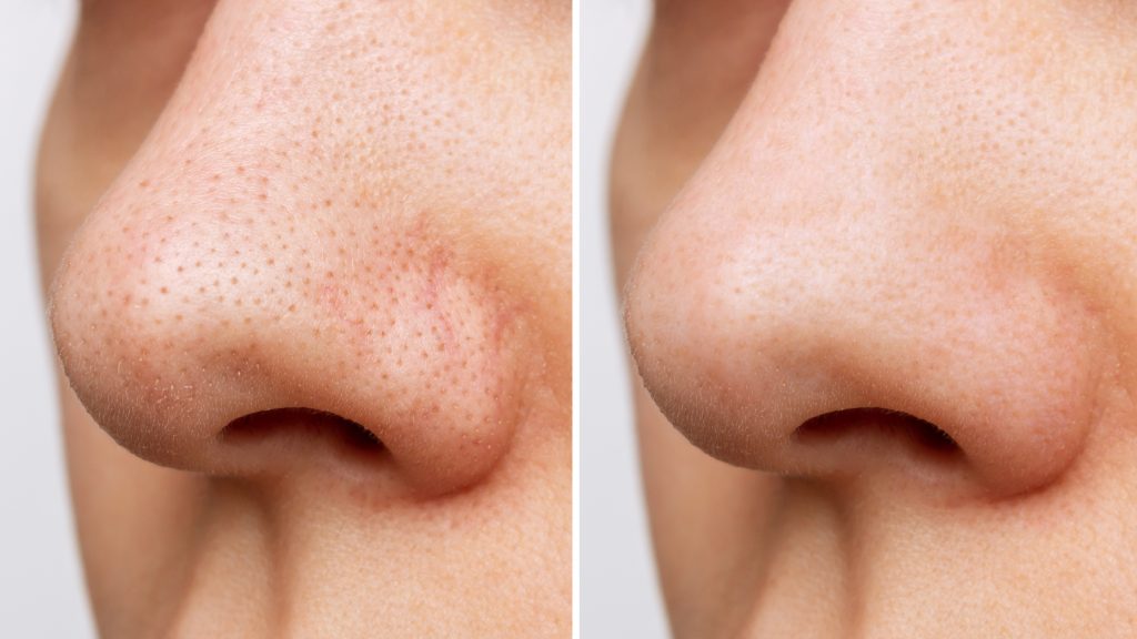 Female Nose With Blackheads Or Black Dots Before And After Peeling And Cleansing The Face