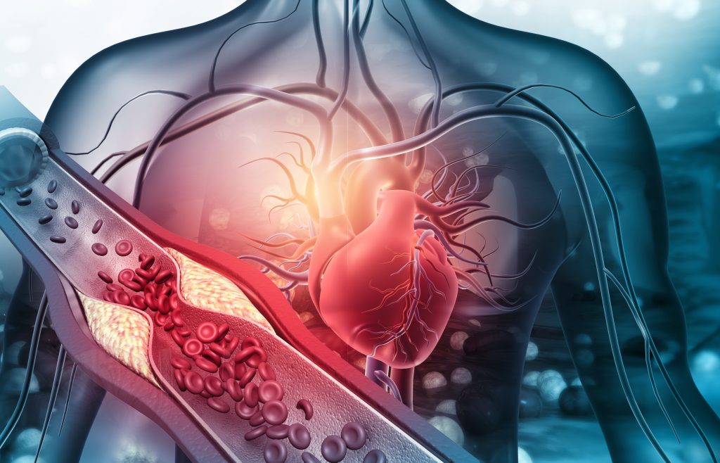 Human Heart With Blocked Arteries