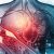 Human Heart With Blocked Arteries