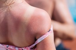 The Red Back Of A Girl With A Sunburn And White Lines From A Swimsuit With A Hotel Pool On The Background