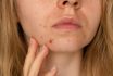 Unrecognizable Woman Showing Her Acne On Face. Close Up Acne On Woman's Face With Rash Skin ,scar And Spot That Allergic To Cosmetics. Problem Skincare And Health Concept