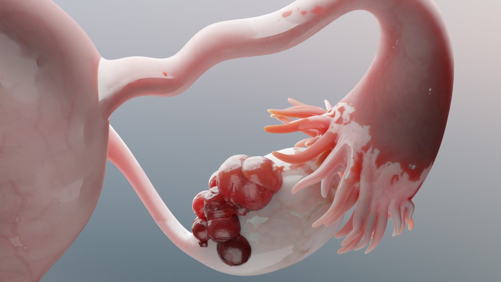 Ovarian Malignant Tumor, Female Uterus Anatomy, Reproductive System, Cancer Cells, Ovaries Cysts, Cervical Cancer, Growing Cells, Gynecological Disease, Metastasis Cancerous, Duplicating, 3d Render