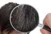 Examiming White Dandruff Flakes In Hair With Magnifying Glass.