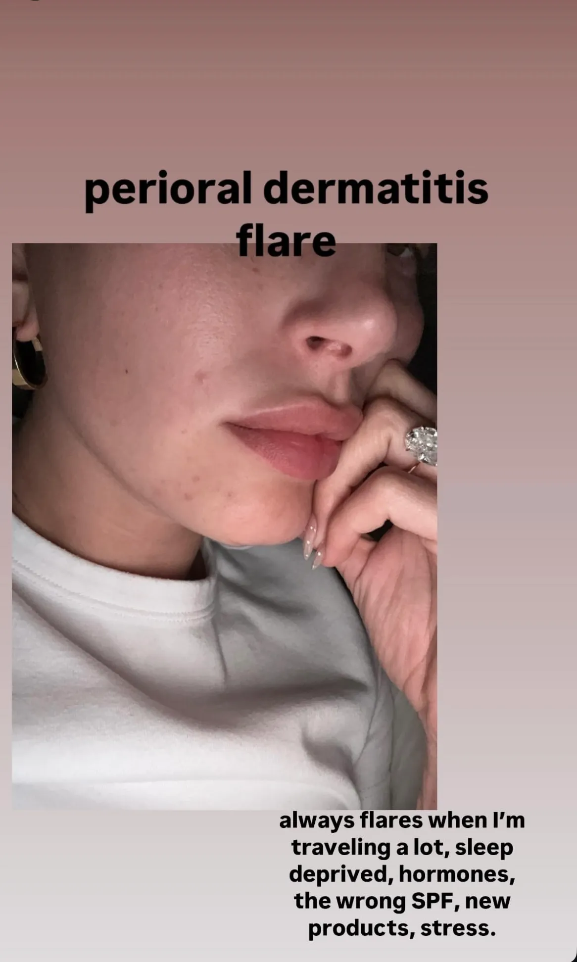 Hailey Bieber megmutatta igazi arcát – így győzi le a makacs bőrproblémáit 1 Hailey Bieber