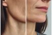 Masseter Botox