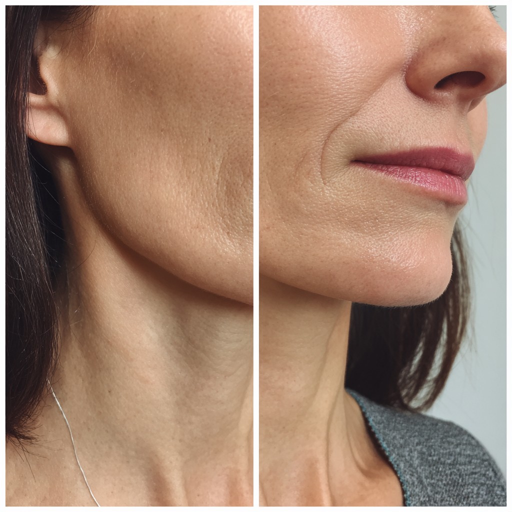 Masseter Botox