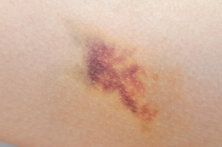 Vitaminhiány véraláfutás